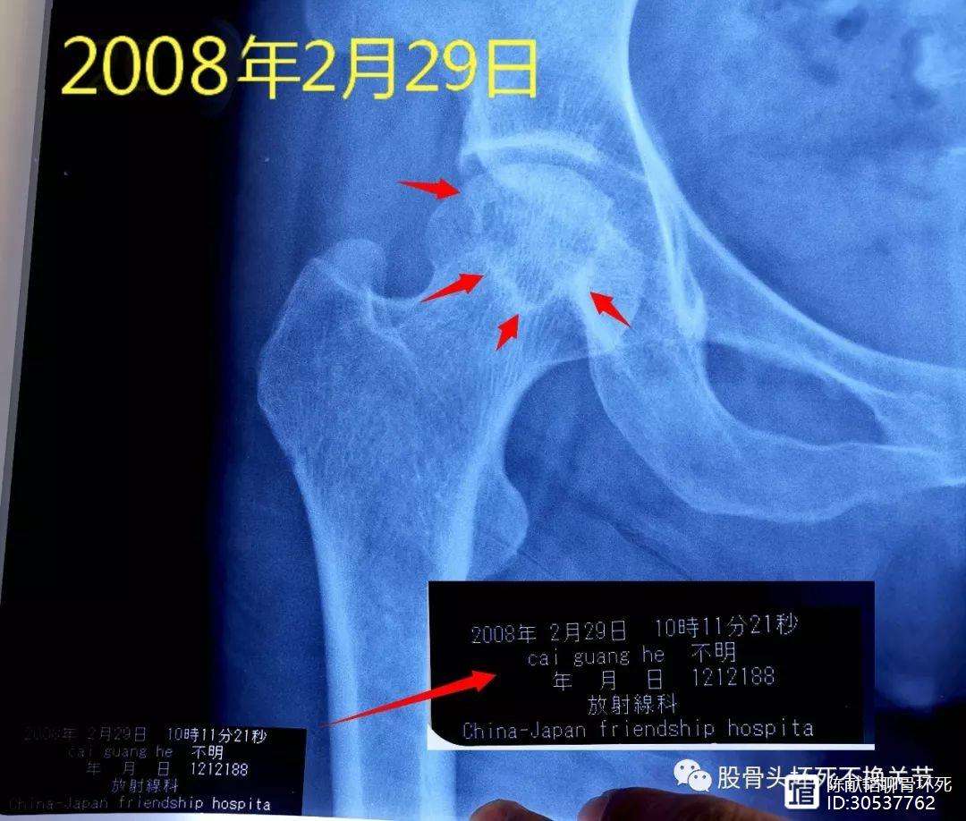 景德镇人工骨头医保报销多少(人工骨头医保报销多少比例)